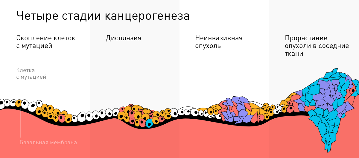 4 стадии канцерогенеза