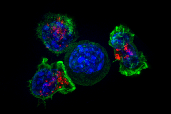  Раковая клетка в окружении T-лимфоцитов