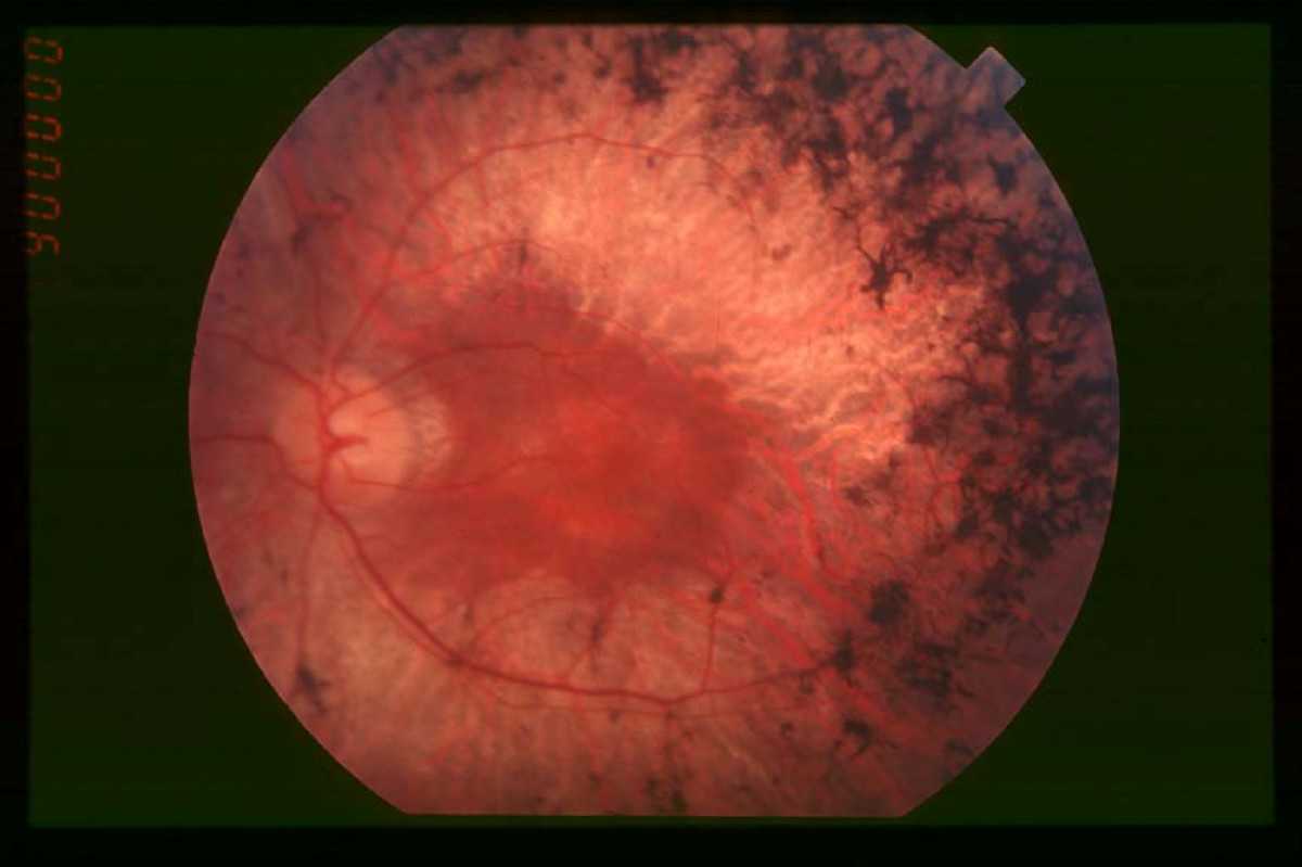 пигментный ретинит