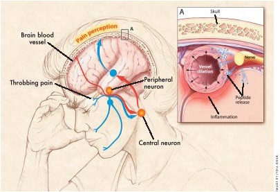 Рисунок 6. Схема развития мигрени. Выделение пептидов тканями нерва (синие точки) приводит к расширению сосуда и воспалению