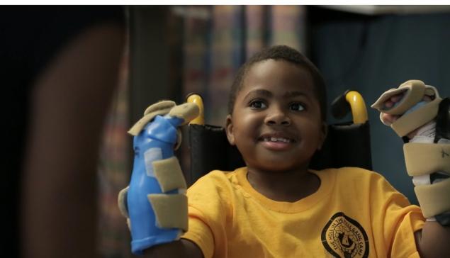 chop completes world apos s bilateral hand transplant