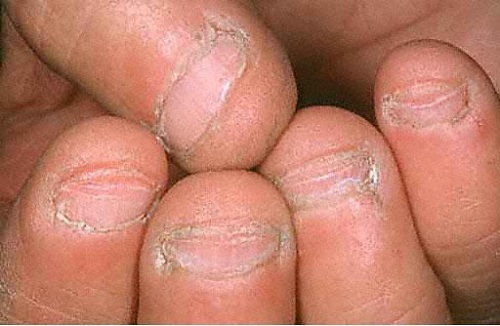сгрызенные ногти