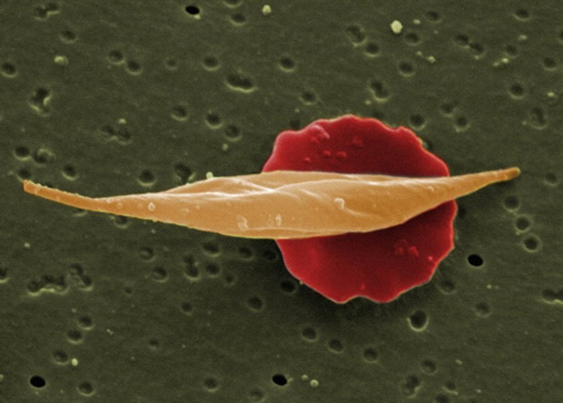 Серповидноклеточную анемию научились лечить с помощью CRISPR